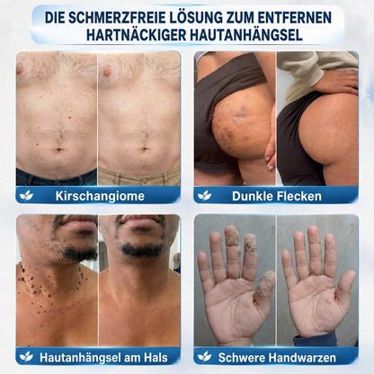 Healrize® 7-Tage Hautmal- & Flecken-Entferner (Schmerzfrei, Narbenfrei mit Rollball-Applikator)🌿🌿